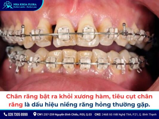 niềng răng hỏng - ảnh 2 niềng răng hỏng - ảnh 2