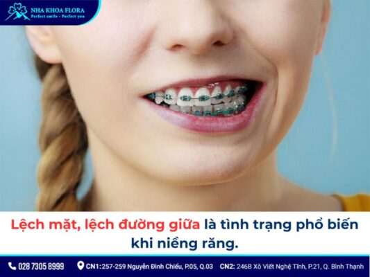 niềng răng hỏng - ảnh 3 niềng răng hỏng - ảnh 3