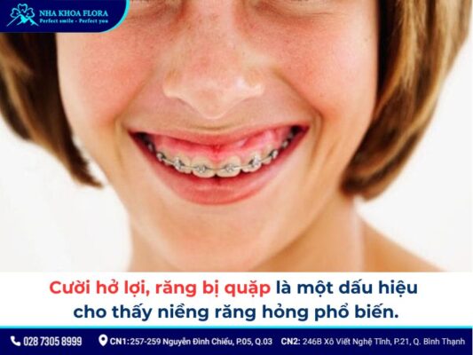 niềng răng hỏng - ảnh 4 niềng răng hỏng - ảnh 4