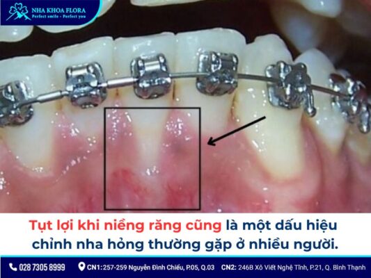 niềng răng hỏng - ảnh 5 niềng răng hỏng - ảnh 5
