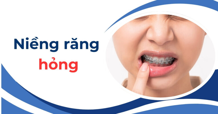 niềng răng hỏng