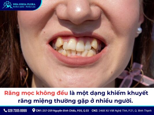 niềng răng không đều - ảnh 1 niềng răng không đều - ảnh 1