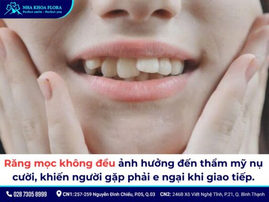 niềng răng không đều - ảnh 2 niềng răng không đều - ảnh 2