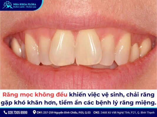 niềng răng không đều - ảnh 3 niềng răng không đều - ảnh 3