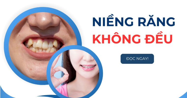 niềng răng không đều
