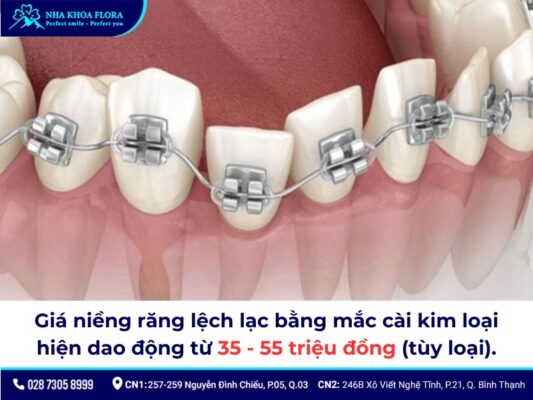 niềng răng lệch lạc giá bao nhiêu - ảnh 1