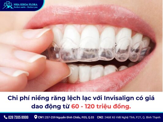 niềng răng lệch lạc giá bao nhiêu - ảnh 3