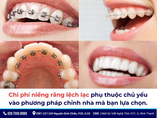 niềng răng lệch lạc giá bao nhiêu - ảnh 4