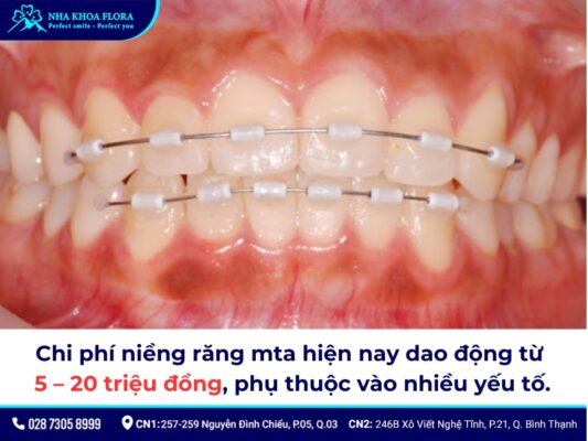 niềng răng mta giá bao nhiêu - ảnh 1