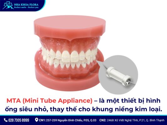 niềng răng mta giá bao nhiêu - ảnh 2
