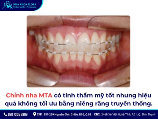 niềng răng mta giá bao nhiêu - ảnh 3