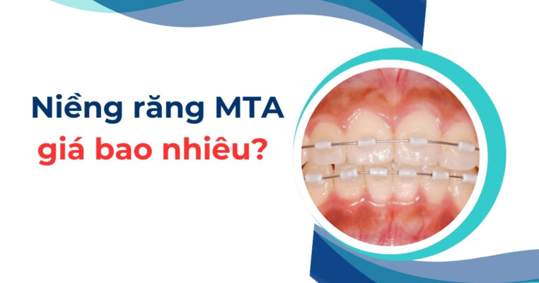 niềng răng mta giá bao nhiêu