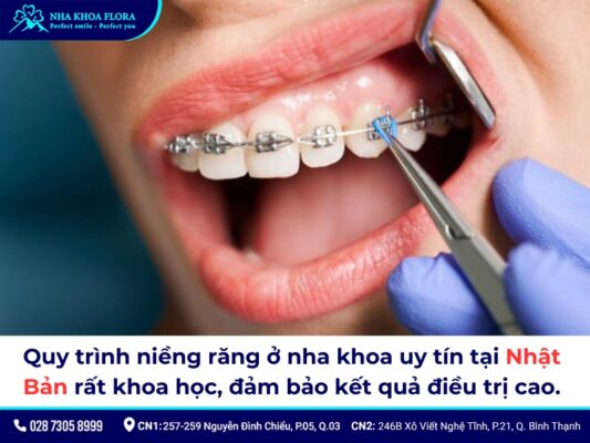 niềng răng ở Nhật giá bao nhiêu - ảnh 2 niềng răng ở Nhật giá bao nhiêu - ảnh 2