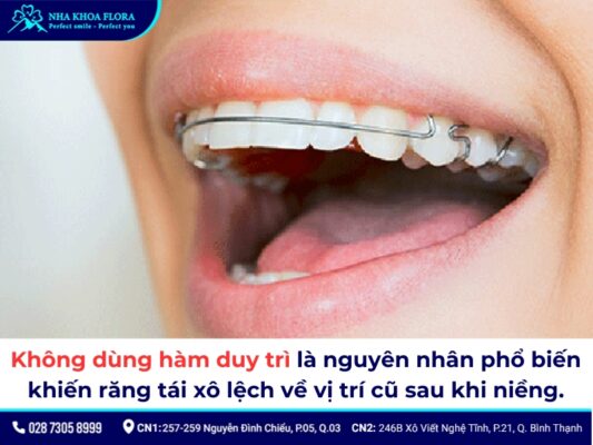 niềng răng xong bị chạy răng - ảnh 2 niềng răng xong bị chạy răng - ảnh 2