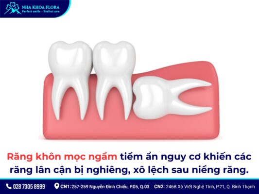 niềng răng xong bị chạy răng - ảnh 4 niềng răng xong bị chạy răng - ảnh 4