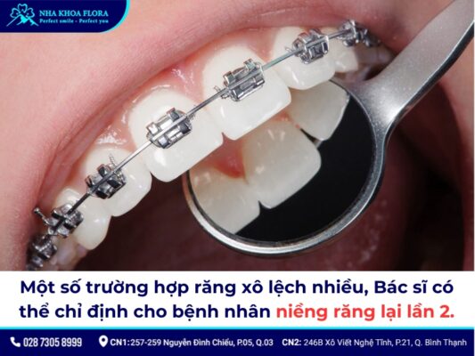 niềng răng xong bị chạy răng - ảnh 7 niềng răng xong bị chạy răng - ảnh 7