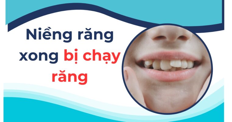 niềng răng xong bị chạy răng