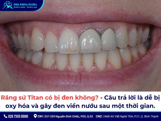 răng sứ Titan có bị đen không - ảnh 1