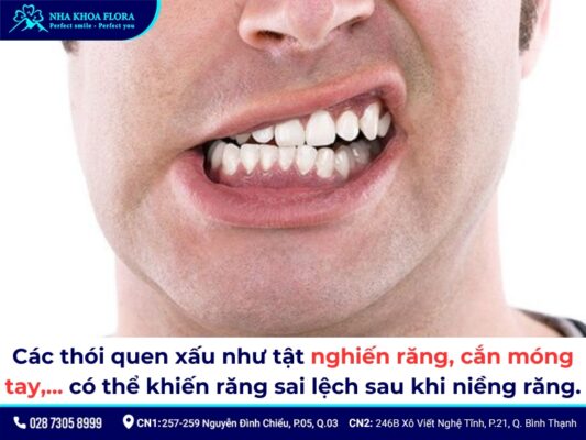 sau khi niềng răng - ảnh 6 sau khi niềng răng - ảnh 6