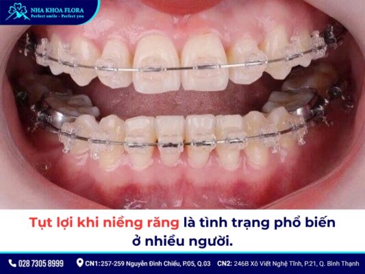 tụt lợi khi niềng răng - ảnh 1 