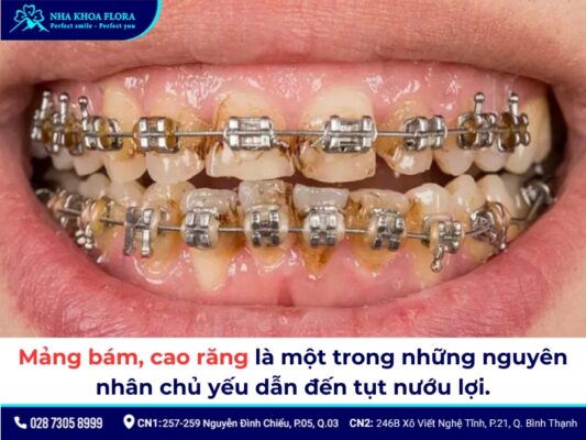 tụt lợi khi niềng răng - ảnh 3