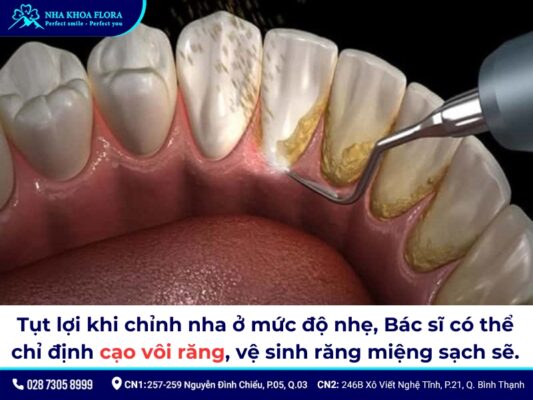 tụt lợi khi niềng răng - ảnh 7