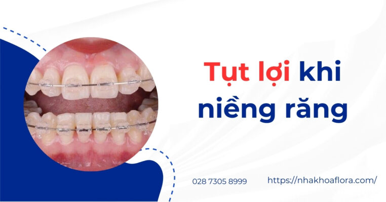 tụt lợi khi niềng răng - ảnh 1