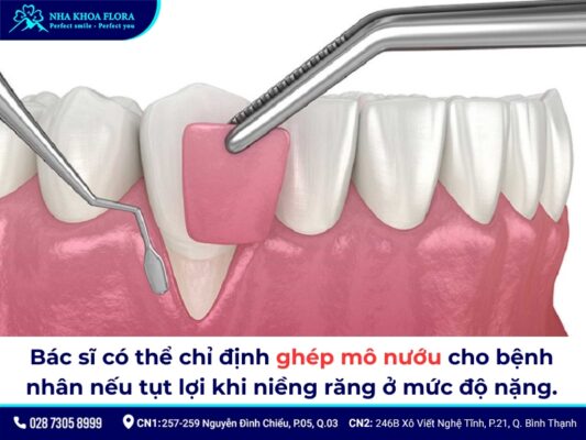 tụt lợi khi niềng răng - ảnh 8