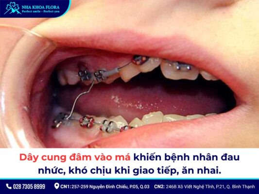 đứt dây cung niềng răng - ảnh 4
