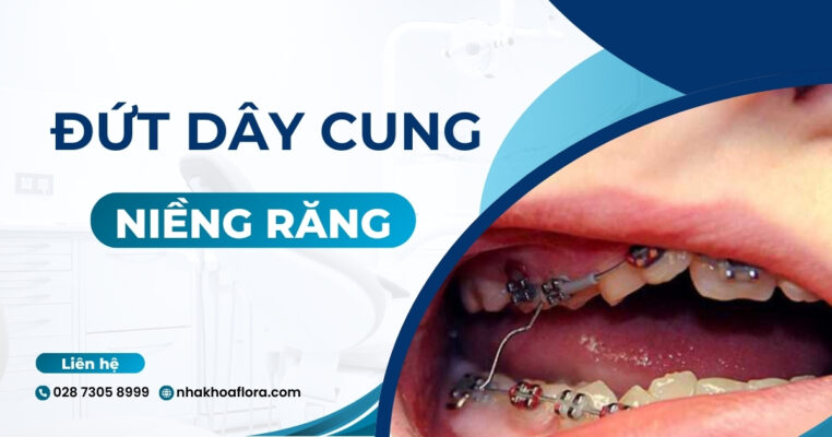 đứt dây cung niềng răng