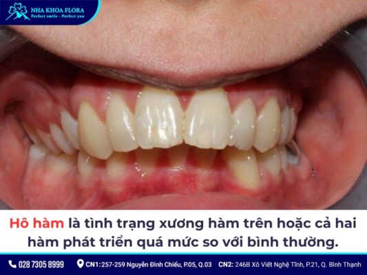 hô hàm có niềng răng được không - ảnh 1