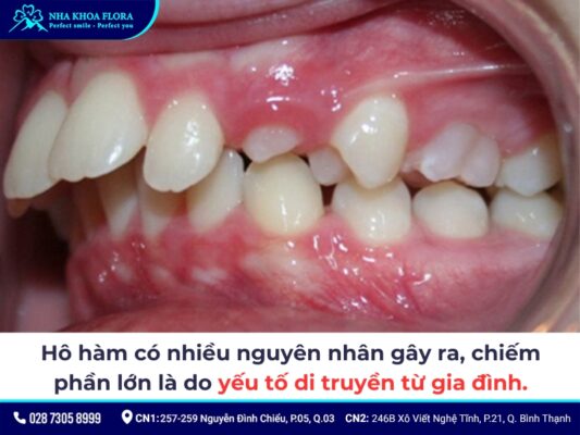 hô hàm có niềng răng được không - ảnh 2