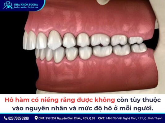 hô hàm có niềng răng được không - ảnh 3
