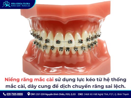 hô hàm có niềng răng được không - ảnh 4