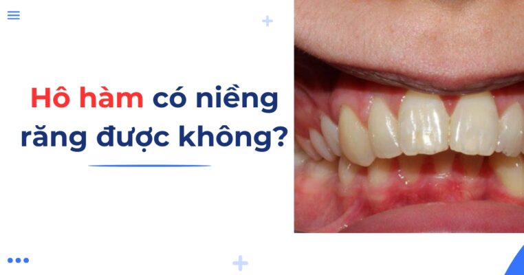 hô hàm có niềng răng được không