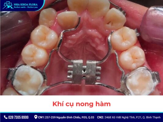 khí cụ niềng răng - ảnh 10