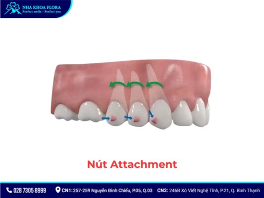 khí cụ niềng răng - ảnh 14