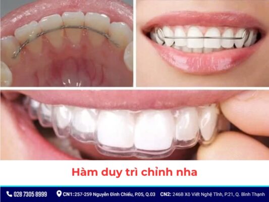 khí cụ niềng răng - ảnh 15