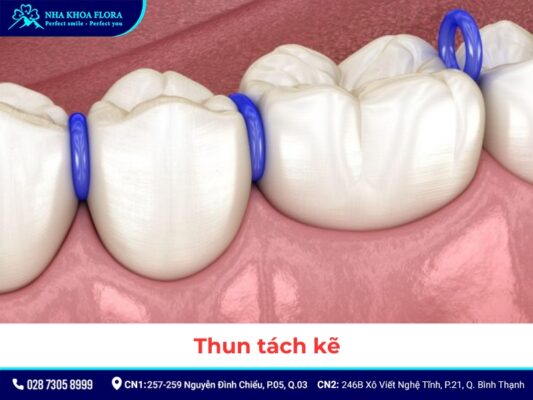 khí cụ niềng răng - ảnh 2