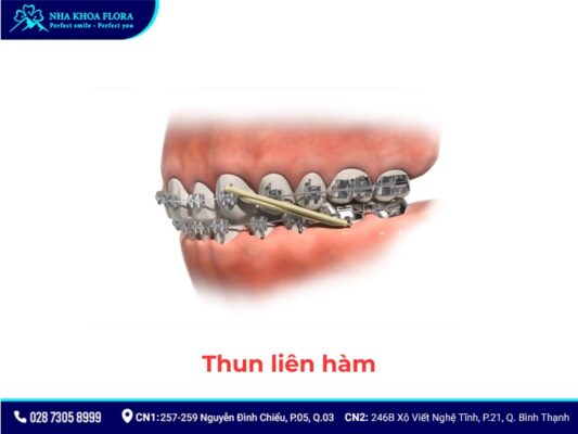 khí cụ niềng răng - ảnh 3