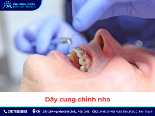 khí cụ niềng răng - ảnh 5