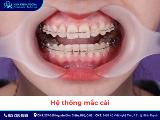 khí cụ niềng răng - ảnh 6