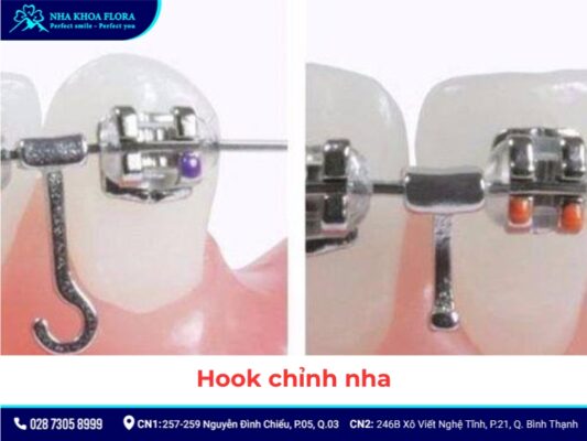 khí cụ niềng răng - ảnh 7