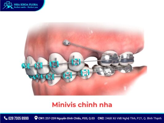 khí cụ niềng răng - ảnh 8