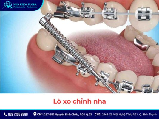 khí cụ niềng răng - ảnh 9