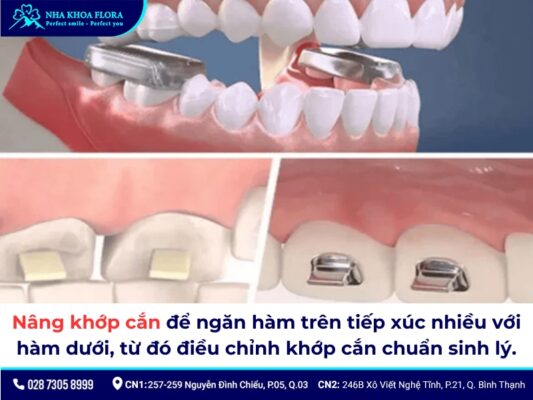 nâng khớp cắn niềng răng - ảnh 1
