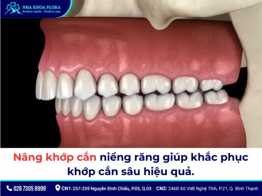 nâng khớp cắn niềng răng - ảnh 2