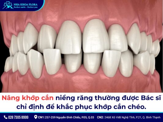 nâng khớp cắn niềng răng - ảnh 3