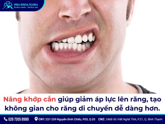 nâng khớp cắn niềng răng - ảnh 4