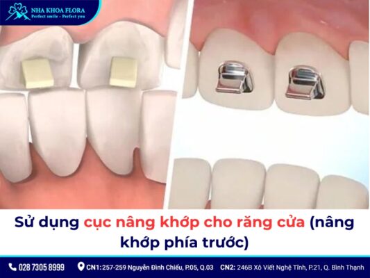 nâng khớp cắn niềng răng - ảnh 6